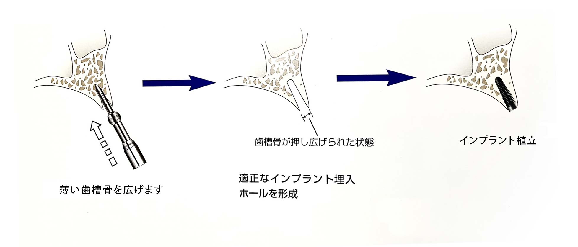 implant_116 implant_116